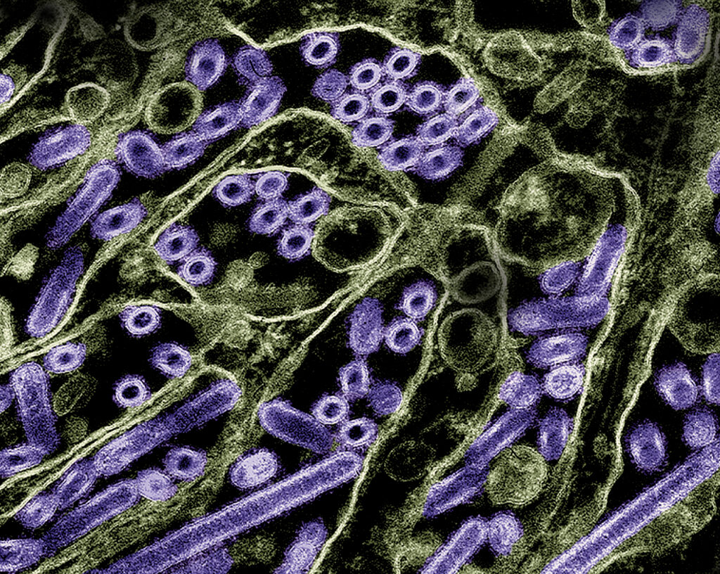 U.S. Reports First Severe Human Case of Bird Flu